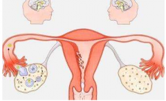 六大宫颈疾病导致宫颈性不孕